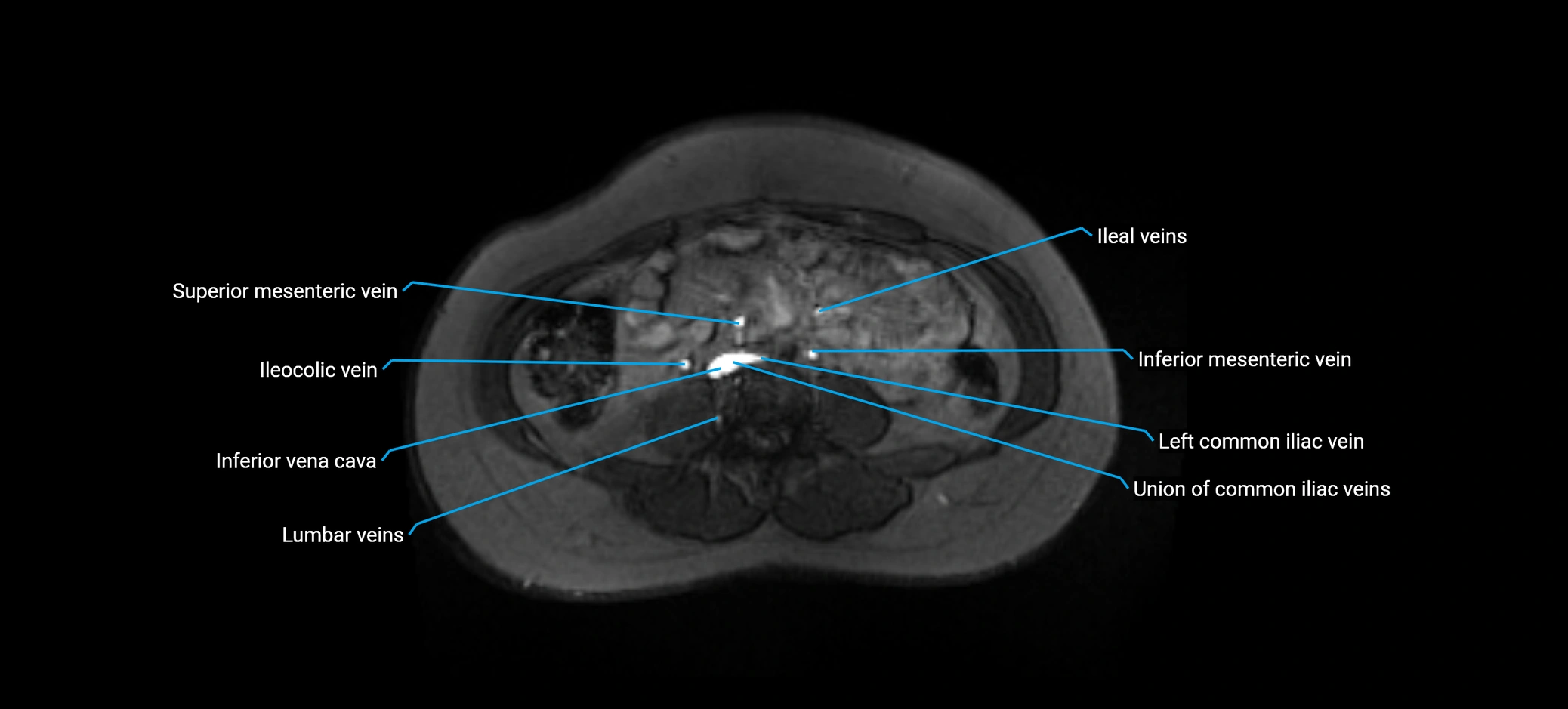 MRV abdomen pelvis & lower limb axial cross sectional anatomy labelled MRI image 106 (1).webp